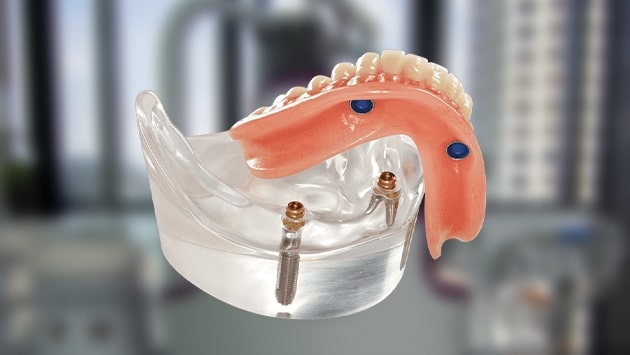 Dentadura Postiza Removible En Tijuana Snap On Denture