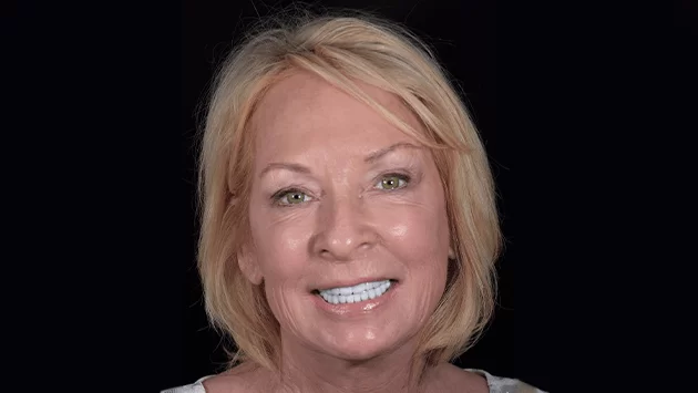 xdentistry paciente all on 4 04