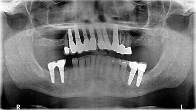 x dentistry implantes panorámicos x ray 01