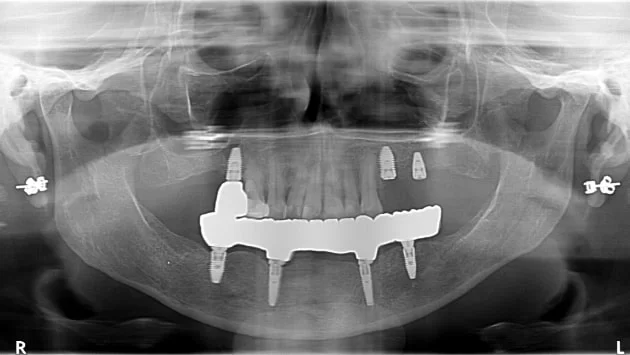 x dentistry implantes panorámicos x ray 02