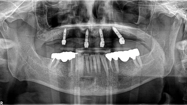 x dentistry implantes panorámicos x ray 03