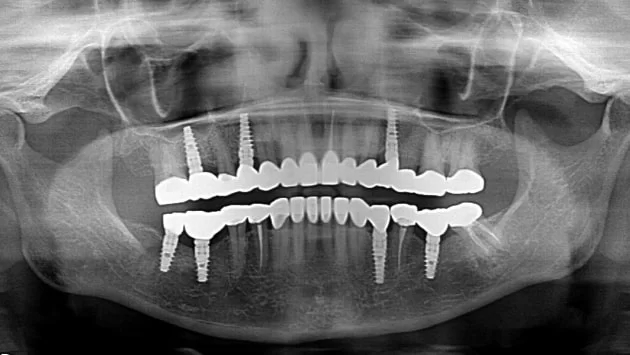 x dentistry implantes panorámicos x ray 04