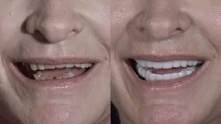 x dentistry Paciente antes y después de los implantes 10 1