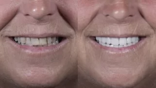 x dentistry Paciente antes y después de los implantes 11 1