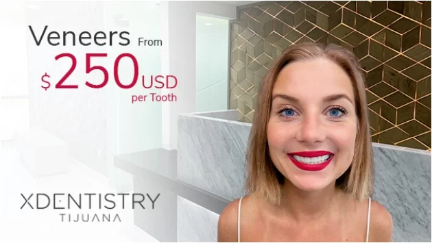 Costo de las carillas