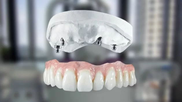 x dentistry carillas antes y despues 02