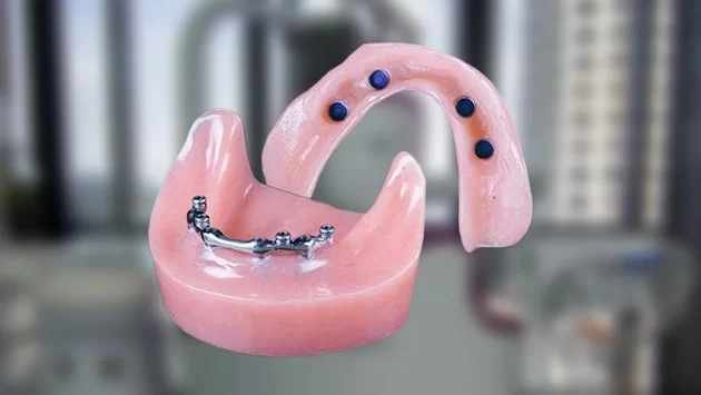 x dentistry Dentadura postiza a presión con barra retenida