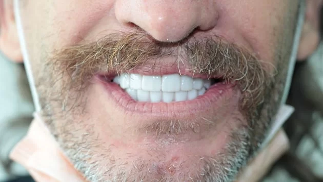 x dentistry blanqueamiento antes y después 01