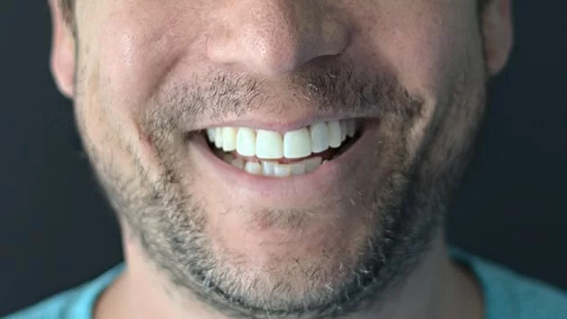 x dentistry blanqueamiento antes y después 02