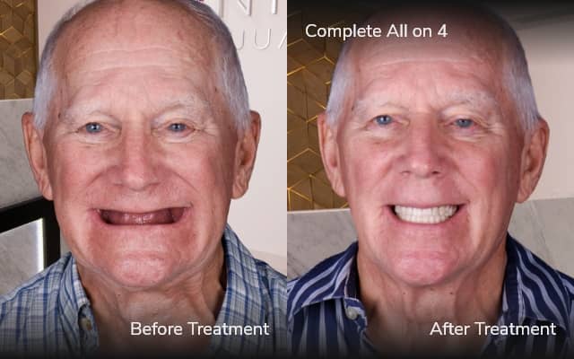 antes y despues de all on 4 tijuana xdentistry 01