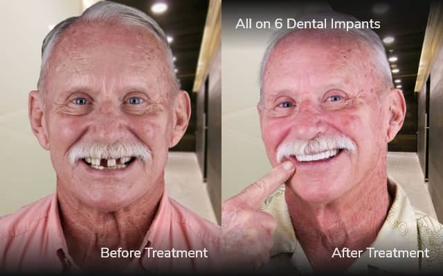 antes y despues de all on 4 tijuana xdentistry 03